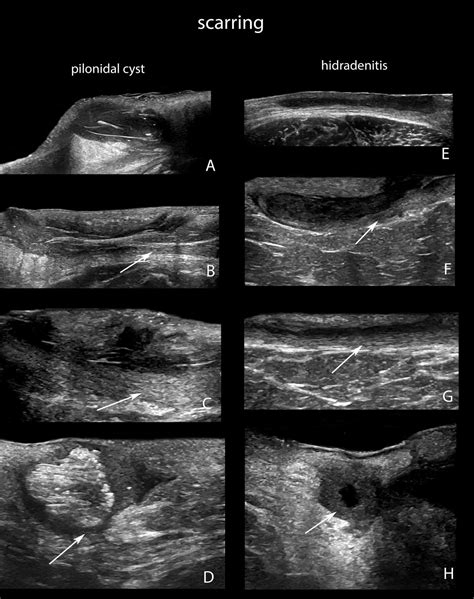 Stages Of Pilonidal Cyst