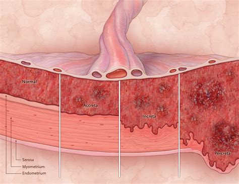 Click to enlarge Placenta Accreta, Advanced Maternal Age, Placental, Antenatal, In Vitro ...