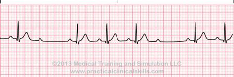 Conduction Disorders (PEARLS) | SMARTY PANCE