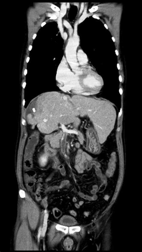 Septic thrombophlebitis of the superior mesenteric vein with bacteraemia caused by Bacteroides ...