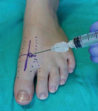 Diagnosis and Management of the Septic Joint | Musculoskeletal Key