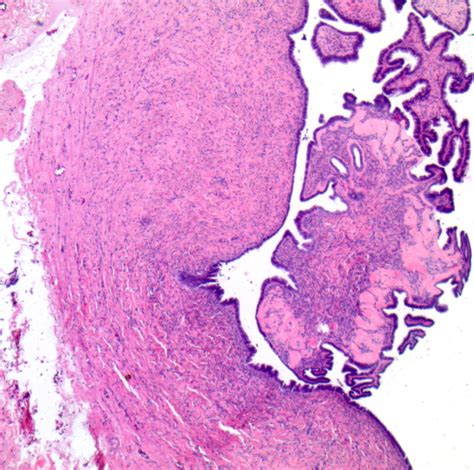 Serous Cystadenoma Ovary Histology