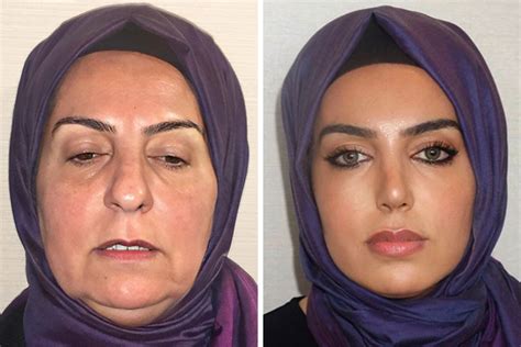 Jaw-Dropping Before And After Pics From Turkish Plastic Surgery Clinic ...