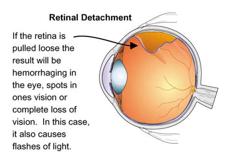 Retinal Detachment: The Signs, Symptoms, and Solutions | Ocular ...