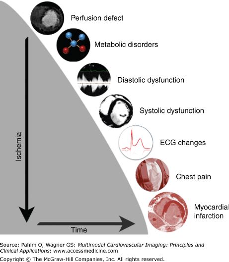 Ischemic Heart Disease | Radiology Key