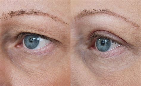 Upper Blepharoplasty - Eyelid Surgery Leeds - Skin Surgery Clinic