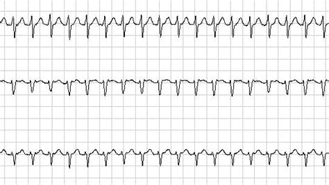 3 Steps to Making the Valsalva Maneuver Effective. | Ditch Doc EM