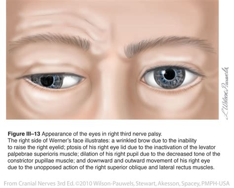 Cranial Nerve 3 Palsy