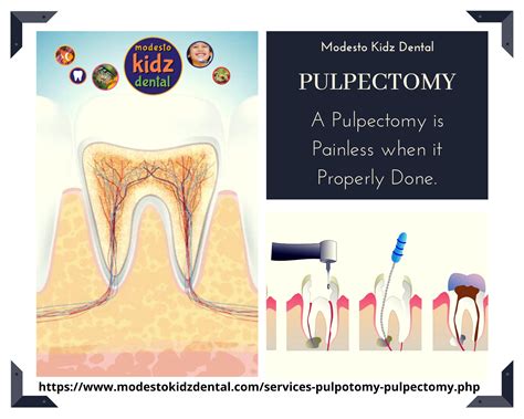 Tooth filling dental Modesto | Pulpectomy | Modesto Kidz Dental | Emergency dentist, Pediatric ...