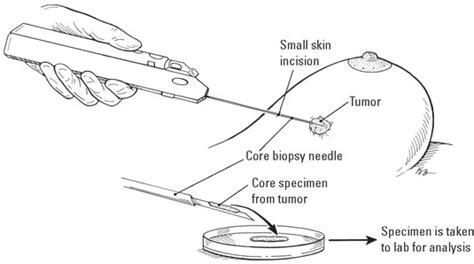 How to Choose a Breast Biopsy Type - dummies