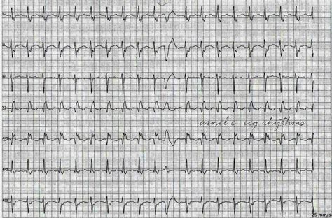 ECG Rhythms: Utility of a PVC in Arrhythmia Diagnosis