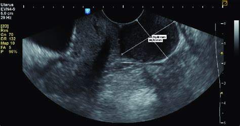 Transvaginal ultrasound imaging. Sagittal view of a mass on the ...