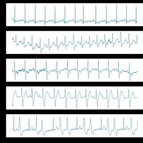 Related work for ECG signal classification using ML and DL classifiers ...