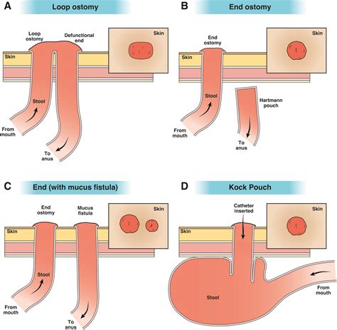 Management of enteral ostomies