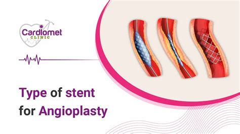 Types of stents in angioplasty, Recovery Time, Post surgery & more