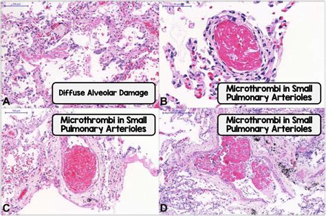 COVID-19: Thrombosis and Hemoglobin - REBEL EM - Emergency Medicine Blog