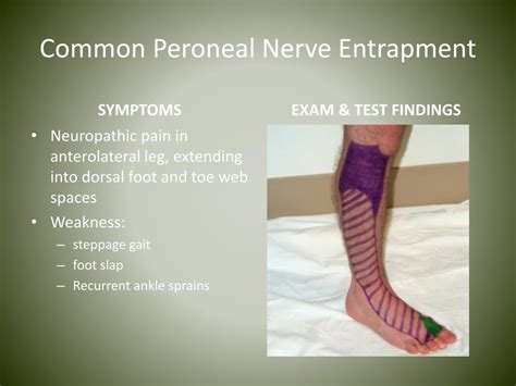 PPT - Nerve Entrapments in Runners PowerPoint Presentation, free download - ID:4539042