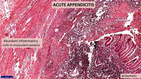 Appendicitis Histology