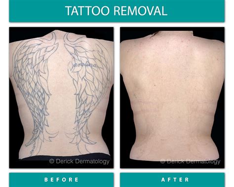 Tattoo Removal, Laser | Chicago| PicoSure | Derick Dermatology