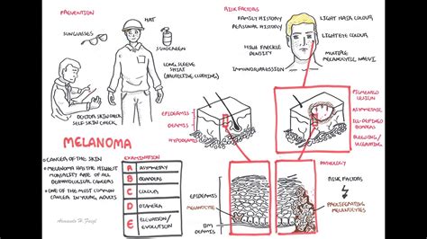 Melanoma - Overview (signs and symptoms, pathology, risk factors ...