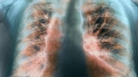 Biotech FibroGen soars on positive lung disease treatment study