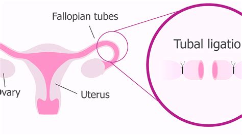 What Are The Side Effects Of Tubal Ligation - Effect Choices