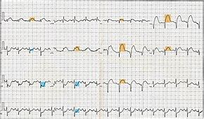 Electrocardiography in myocardial infarction - Wikipedia