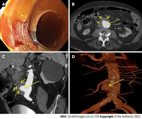 Role of multidetector computed tomography angiography in non-variceal upper gastrointestinal ...