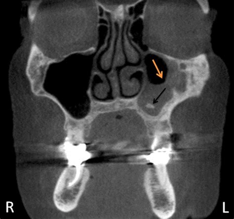 antrolith sagittal view – Dr. G's Toothpix