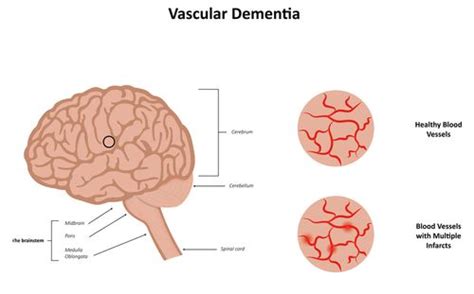 Impacts of Dementia on the Brain | Lakeside Manor