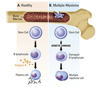 Multiple Myeloma Stages | New Health Advisor