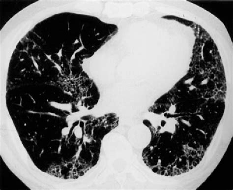 Figure 3 from Chronic bird fancier's lung presenting with acute exacerbation due to use of a ...