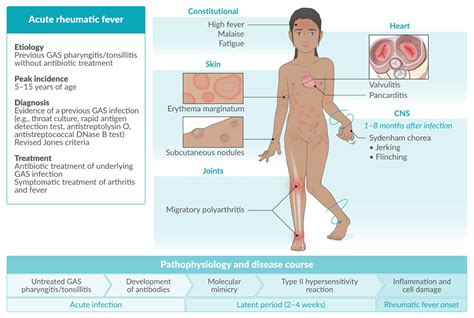 Rheumatic Fever Pathogenesis