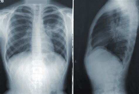 Anterior-posterior and lateral chest radiograph of bilateral hilar ...