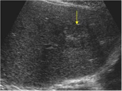 Abdomen and retroperitoneum | 1.1 Liver : Case 1.1.1 Focal nodular ...