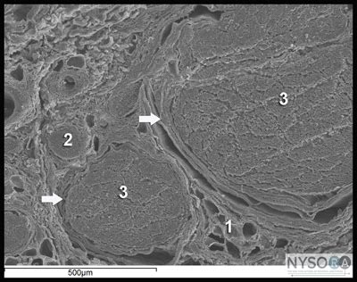 Neurologic Complications of Peripheral Nerve Blocks - NYSORA The New ...