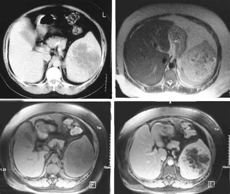 (A) Enhanced CT scan revealed a large, ill-defined hypodense lesion;... | Download Scientific ...