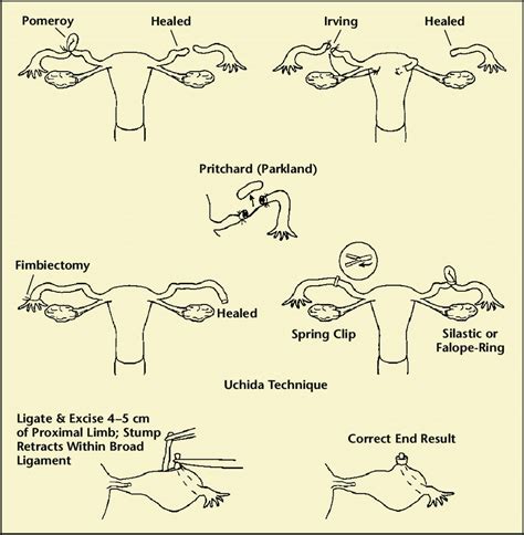 Tubal Ligation Diagram