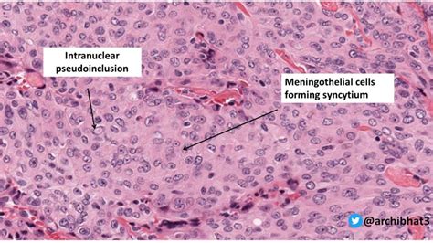 Pathology of Meningioma - Pathology Made Simple