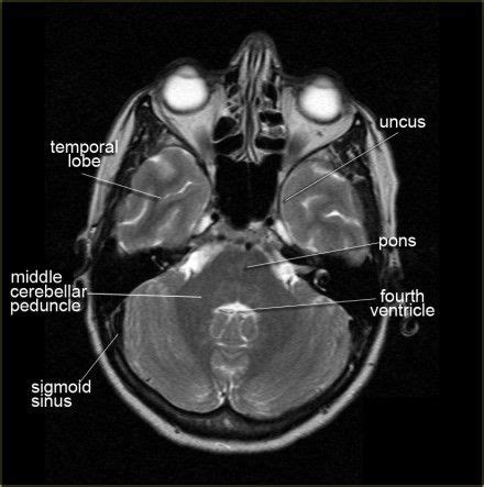 Cerebral Peduncle Mri