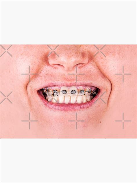 "Funny braces laugh" Mask by munizz | Redbubble