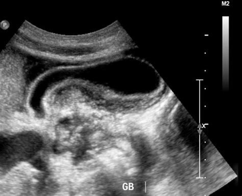 Systemic lupus erythematosus ultrasound or echocardiography - wikidoc