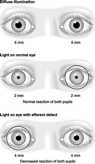 AccessLange: General Ophthalmology ; Chapter 14: Neuro-ophthalmology, Page 5