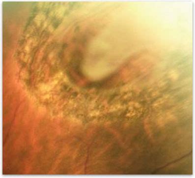 Retinal Tear - Retina-Vitreous Surgeons of CNY