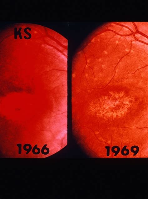 Bull's Eye Maculopathy With Flecks - Retina Image Bank