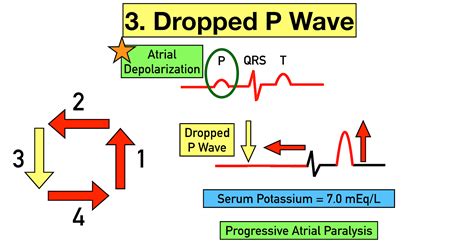 Hyperkalemia ECG Changes, Findings, and Progression of Effects on the ...