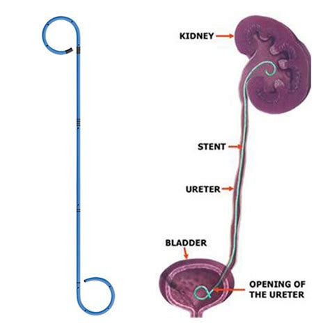 Double J Ureteral Stent