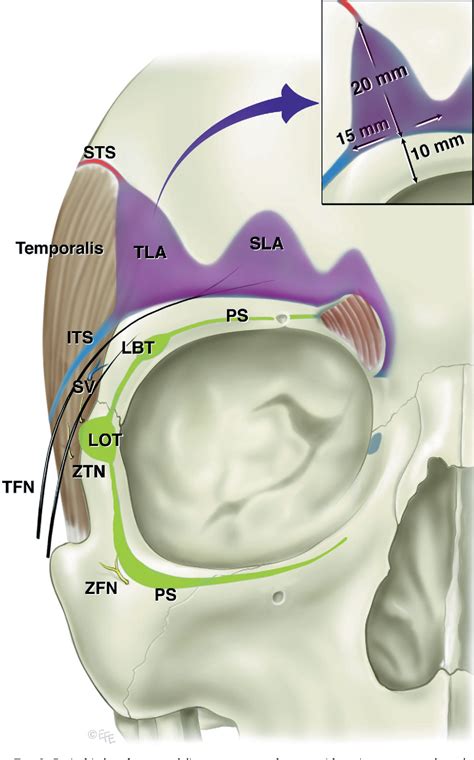 [PDF] Surgical anatomy of the ligamentous attachments in the temple and ...