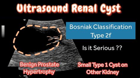 Renal Cyst Type 2f Bosniak Classification | Ultrasound | other Kidney Type 1 Small Cyst ...