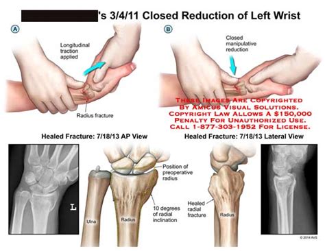 Closed Reduction of Left Wrist